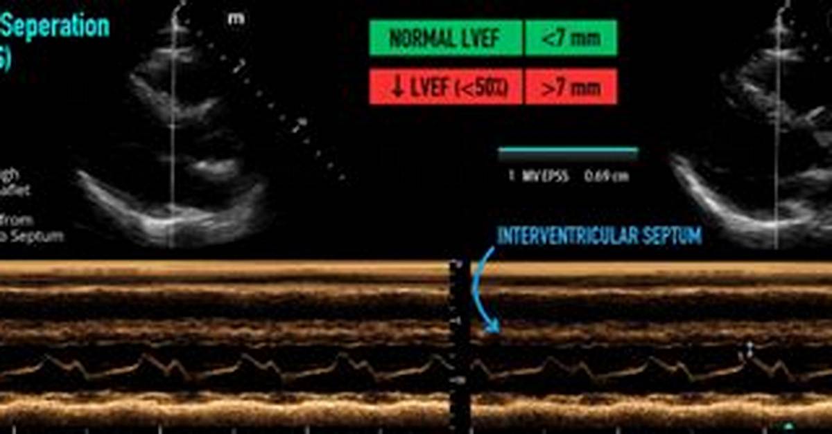 What Is Epss Echo