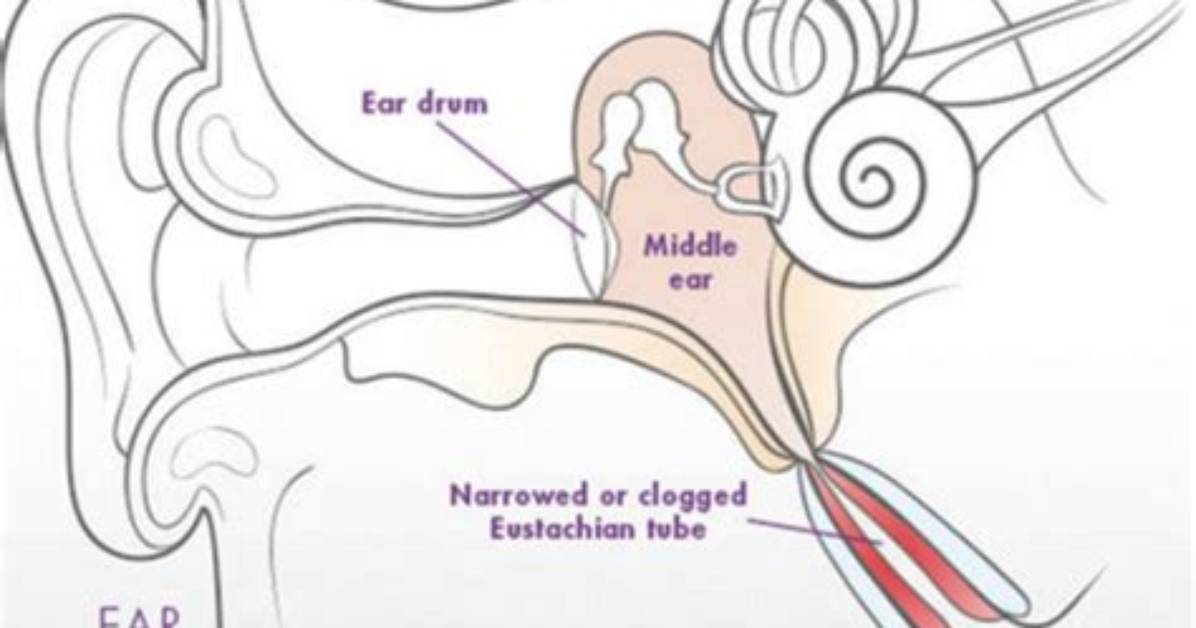 What Is Eustachian Dysfunction?