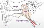What Is Eustachian Dysfunction?