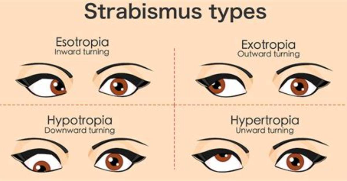 What Is Eye Misalignment?