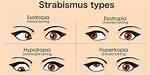 What Is Eye Misalignment?