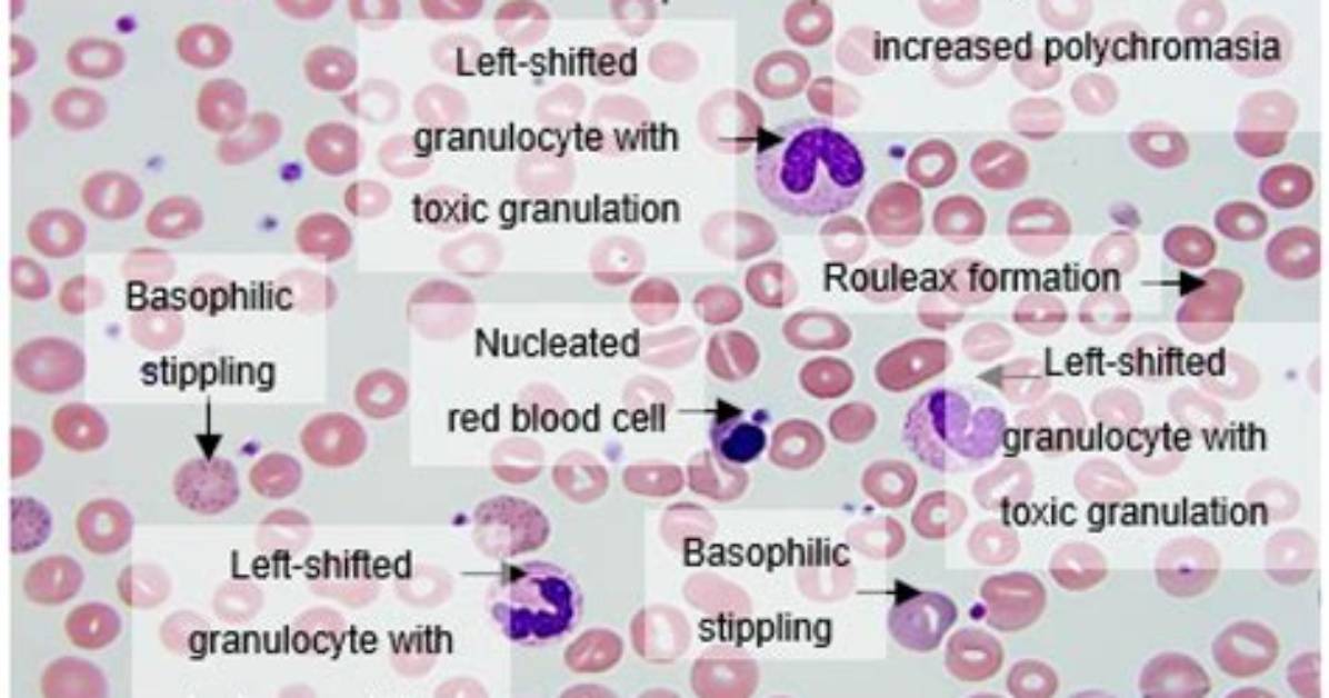 What Is Hematologic Abnormalities?