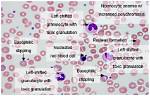 What Is Hematologic Abnormalities?