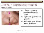 What Is Hyperfunctional Dysphonia?