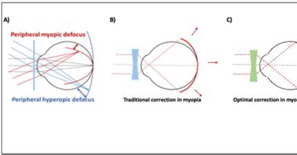 What Is Hyperopic Defocus?