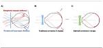 What Is Hyperopic Defocus?