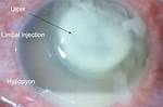 What Is Hypopyon?