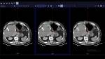 What Is Interventional Ct