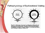 What Is Irritative Voiding?