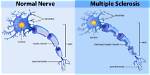 What Is Multiple Sclerosis?