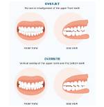 What Is Overbite Teeth?