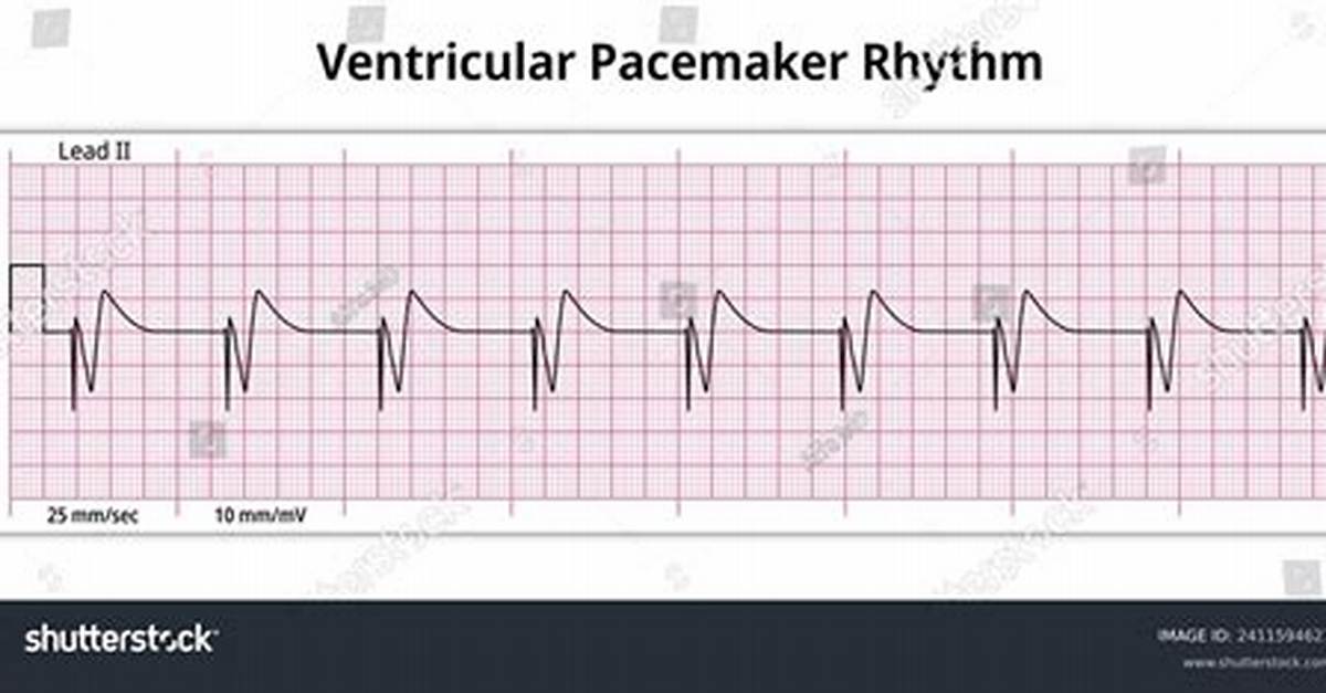 What Is Pacemaker Rhythm