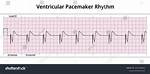 What Is Pacemaker Rhythm