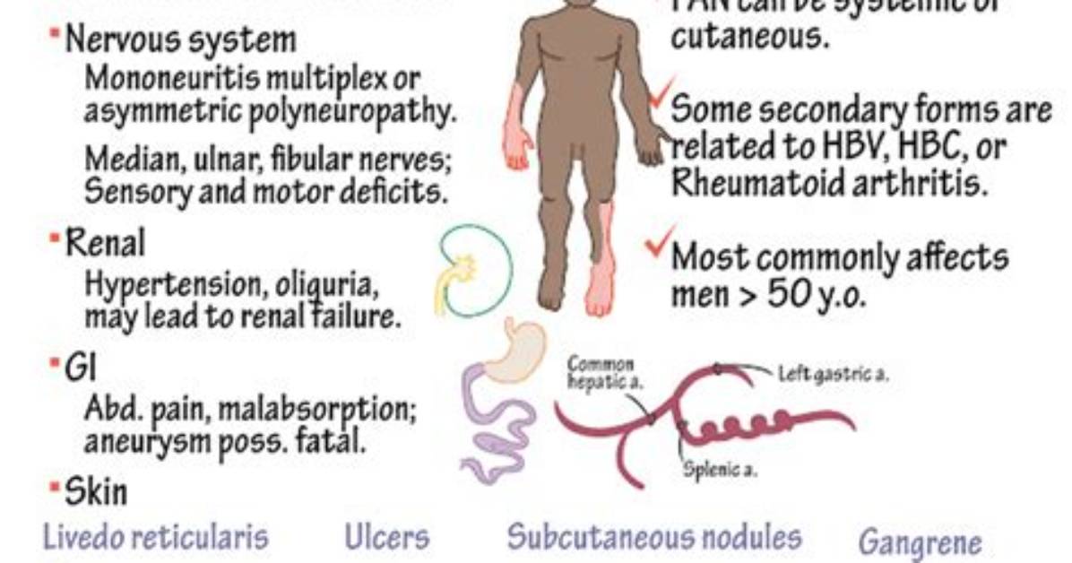 What Is Polyarteritis