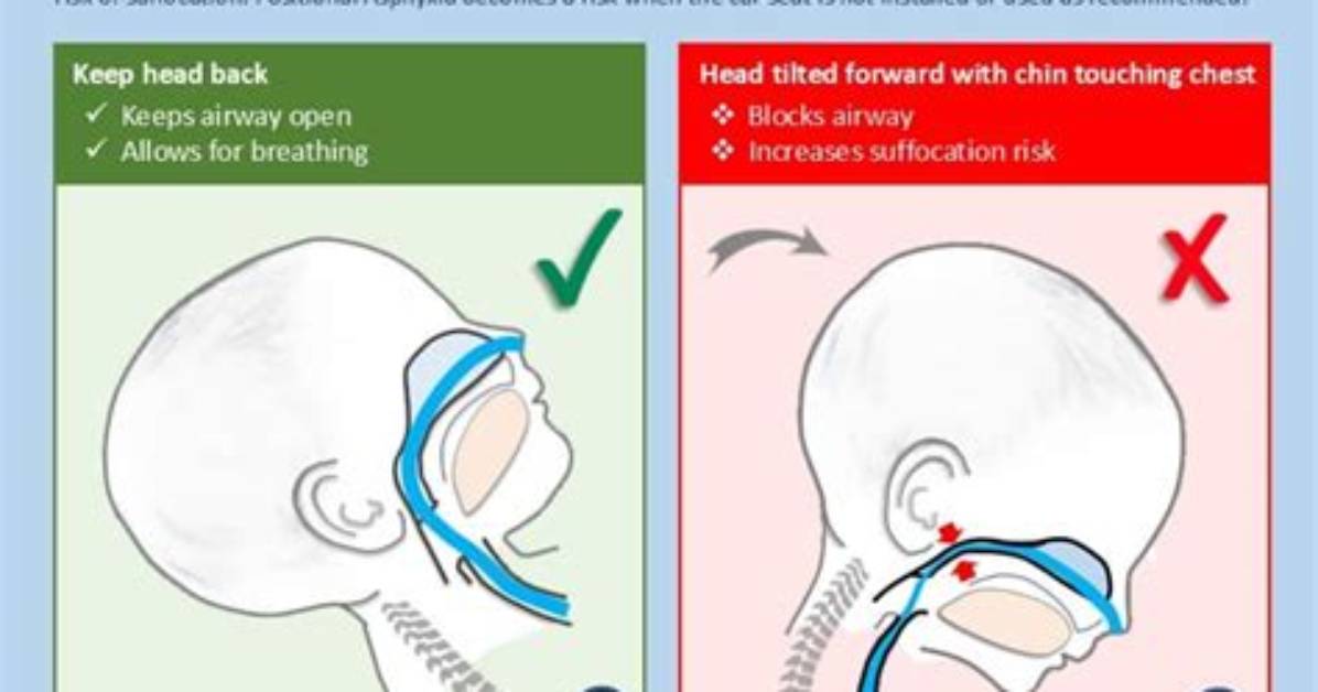 What Is Positional Asphyxia?