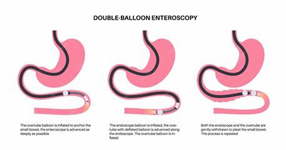 What Is Push Enteroscopy?