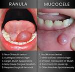 What Is Ranula?