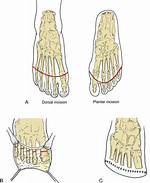 What Is Ray Amputation