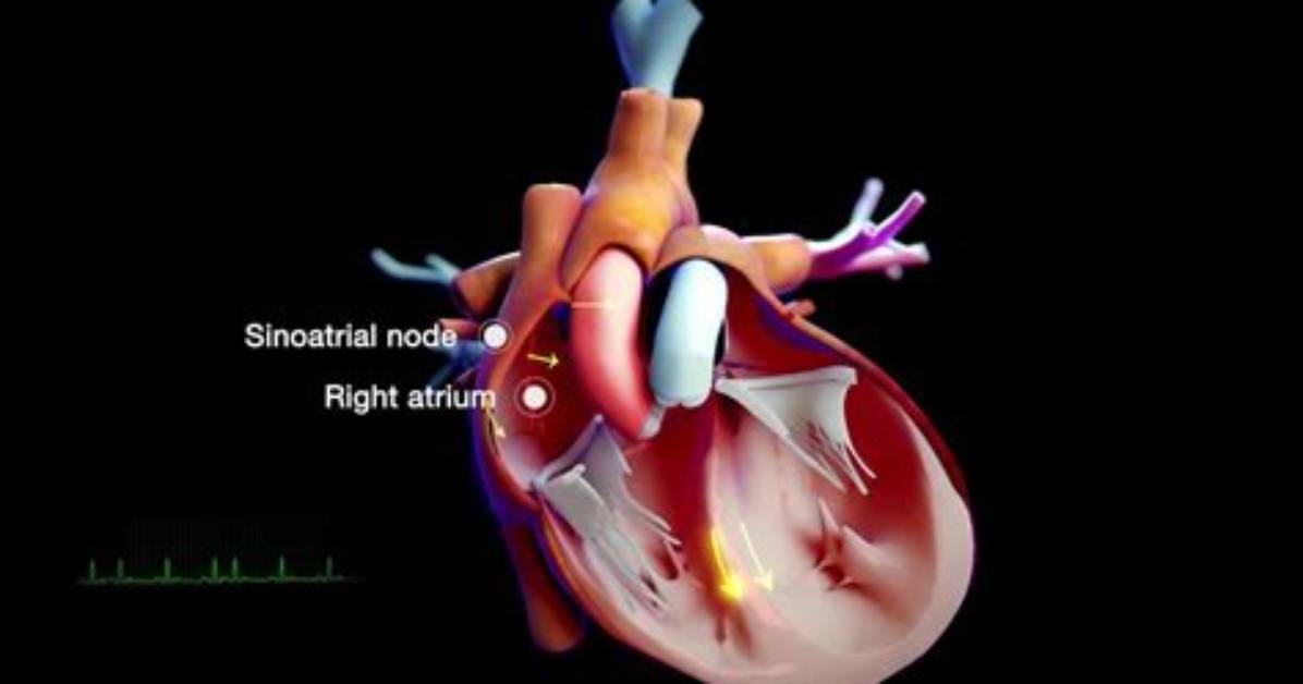 What Is Sinoatrial Node Dysfunction?