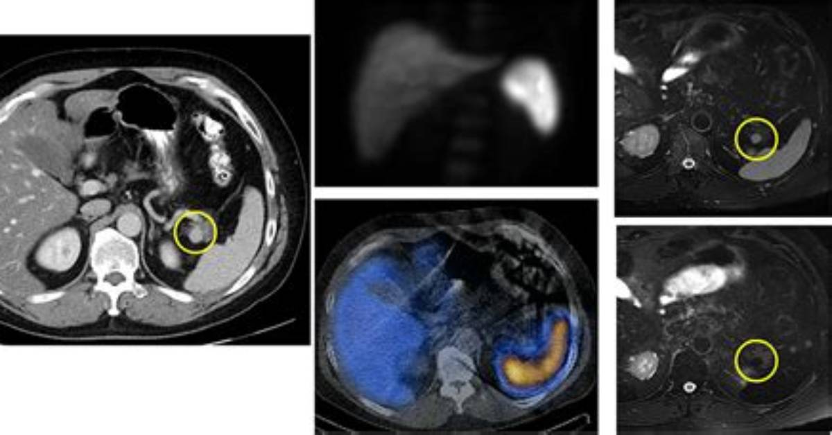 What Is Splenule? | Contextresponse. Com