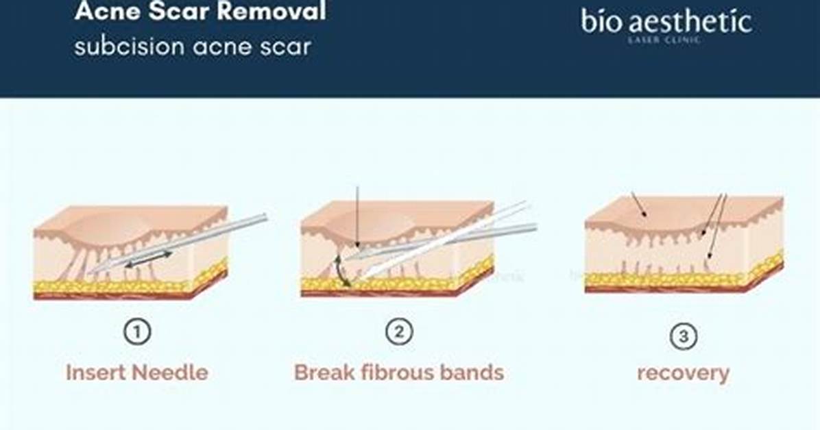 What Is Subcision Procedure?