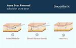 What Is Subcision Procedure?
