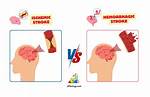 What Is the Difference Between a Stroke and a Cerebral Infarction?