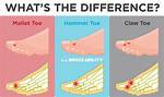 What Is the Difference Between Hammer Toe and Claw Toe?