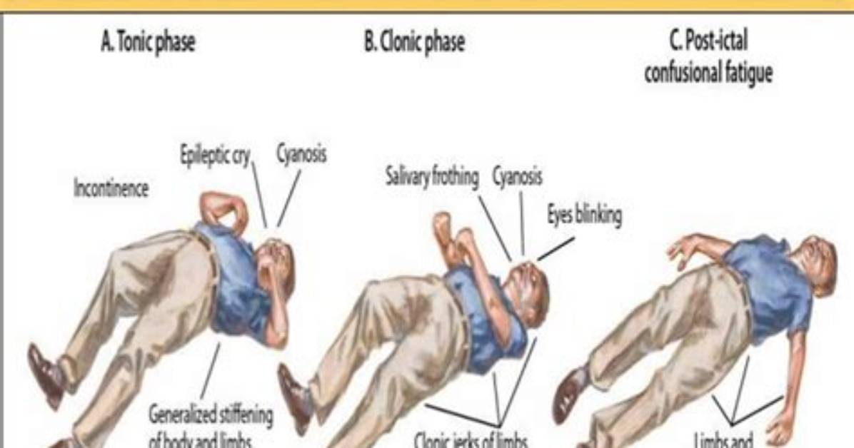 What Is Tonic Posturing? | Contextresponse. Com