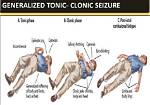 What Is Tonic Posturing? | Contextresponse. Com