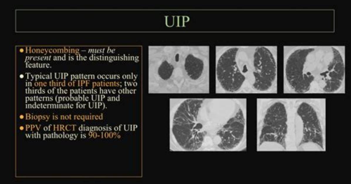 What Is Uip Pattern?
