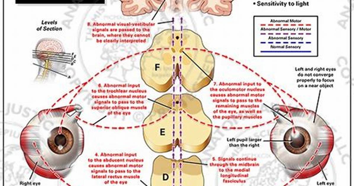 What Is Visual Vestibular Dysfunction?