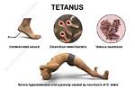 What Kills Tetanus Spores