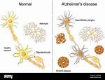 What Neurons Are Affected by Alzheimer's?