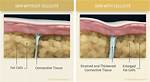 What Really Causes Cellulite?