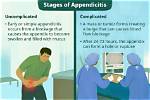 What Ruptures an Appendix?