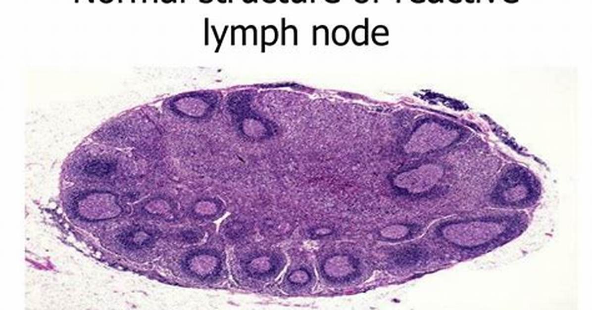 What's a Reactive Lymph Node?