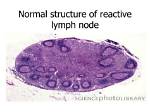 What's a Reactive Lymph Node?