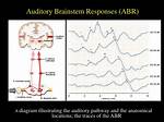What's Auditory Brainstem Response?