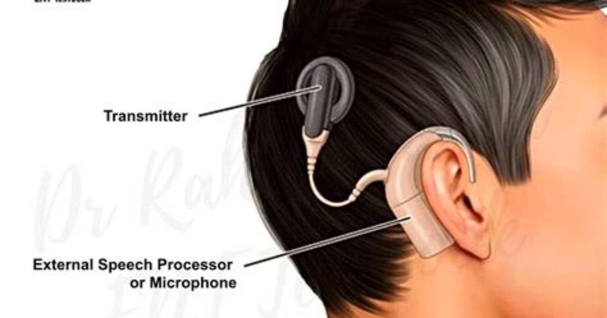 What's Does Cochlear Mean?
