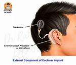 What's Does Cochlear Mean?