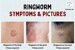 What Temperature Will Kill Ringworm? Check This out | What Temperature Kills Ringworm