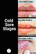 What Triggers Cold Sores?