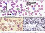 What Would Cause Large Platelets