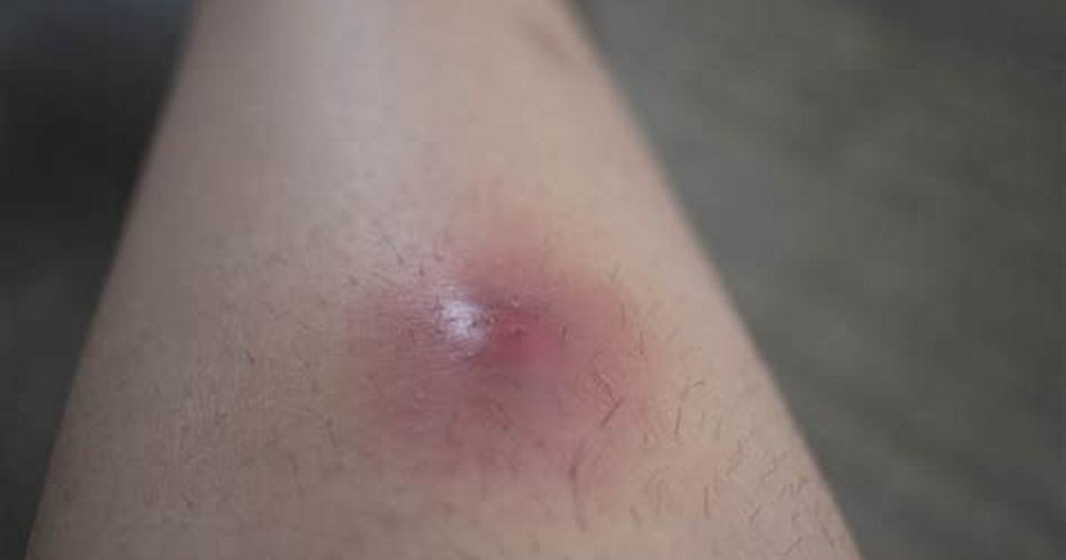 When a Boil Gets Soft?