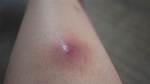 When a Boil Gets Soft?
