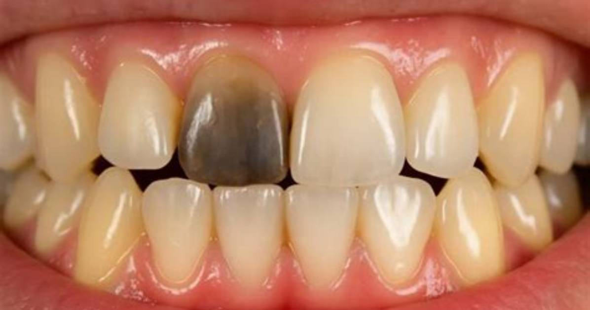 When a Tooth Darkens?