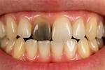 When a Tooth Darkens?