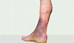 When Ankle Is Black?
