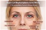 When Blepharoplasty Gone Wrong?